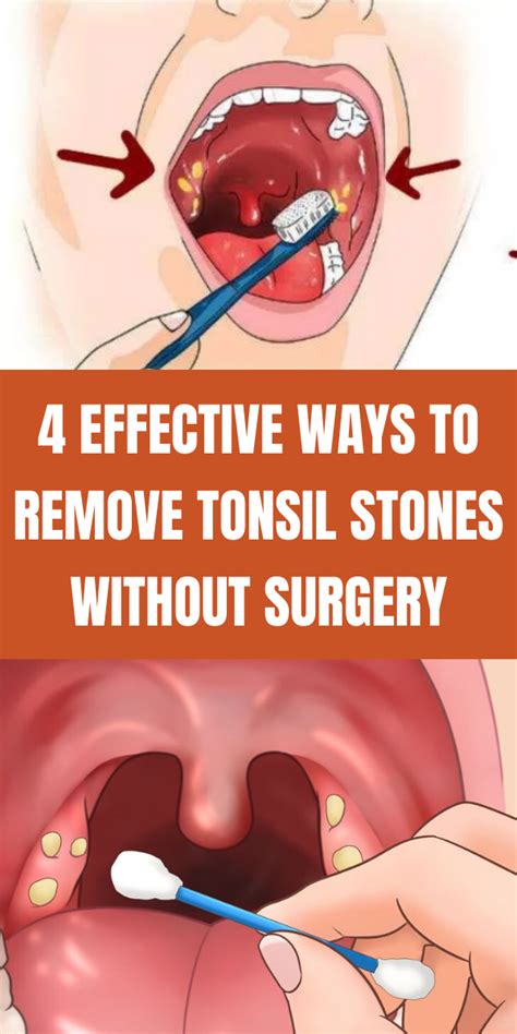 vacuum for tonsil stones|how to remove tonsil stones at home.